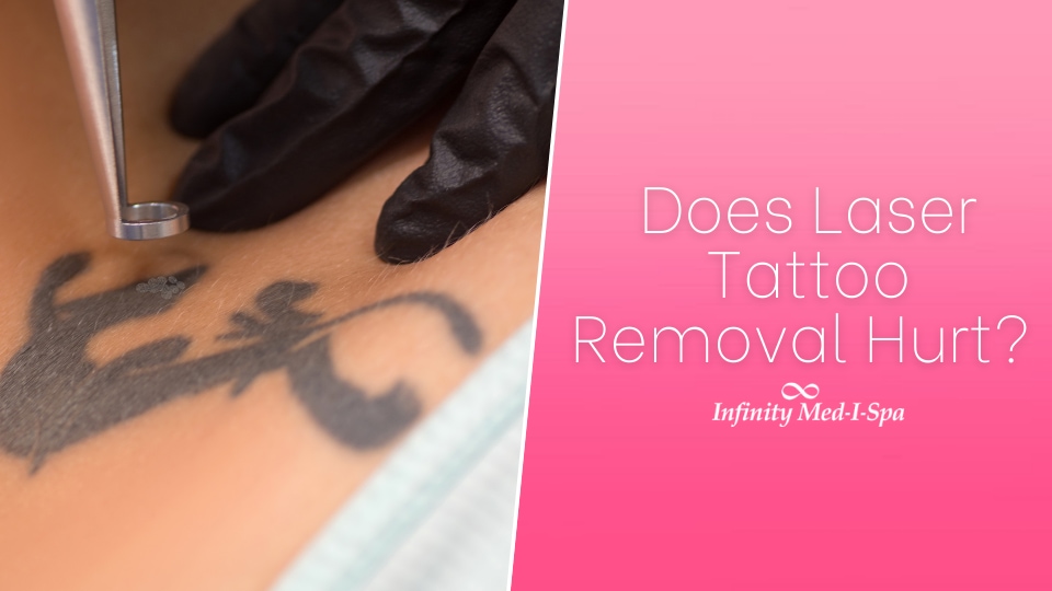 Laser Tattoo Removal - Grace Skincare Clinic