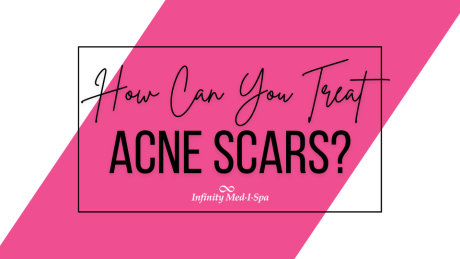 How Can You Treat Acne Scars?