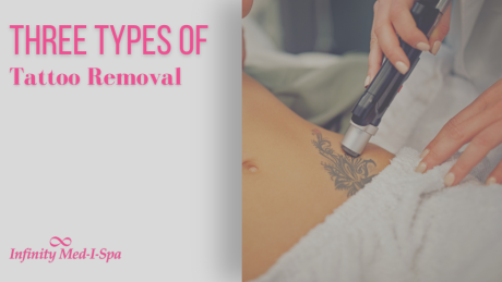 Three Types of Tattoo Removal