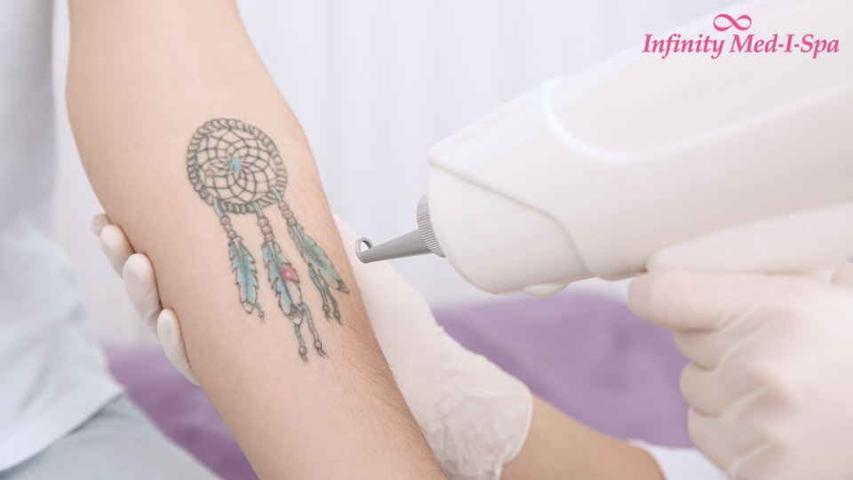 Select the Right Laser for Your Tattoo Removal Columbus OH